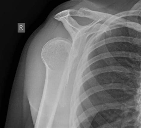 Posterior Shoulder Dislocation • LITFL • Trauma Library