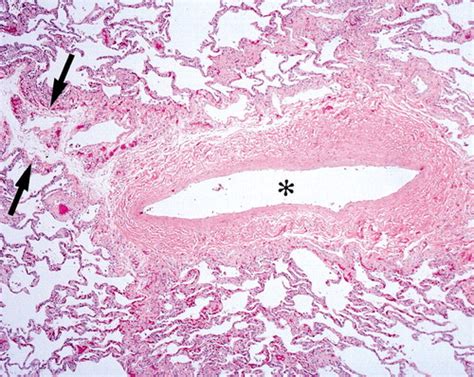 Pulmonary Artery Histology