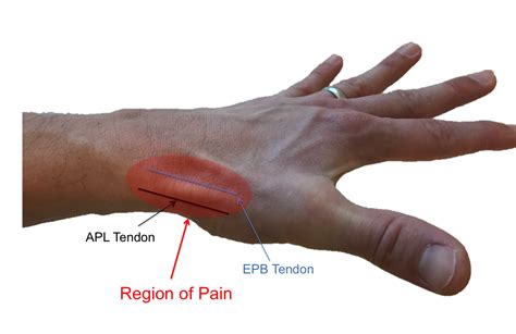 de Quervain Tendonitis - Raleigh Hand Surgery — Joseph J. Schreiber, MD