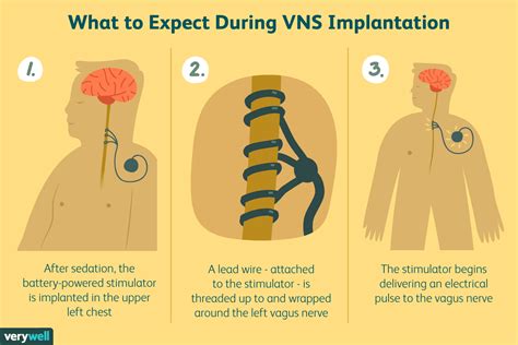 Vagal Nerve Stimulator for Epilepsy Seizure Prevention