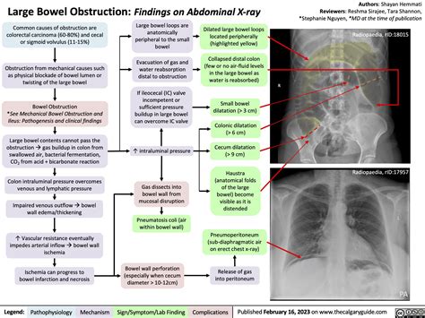 Large Bowel Obstruction: Findings on Abdominal X-ray | Calgary Guide