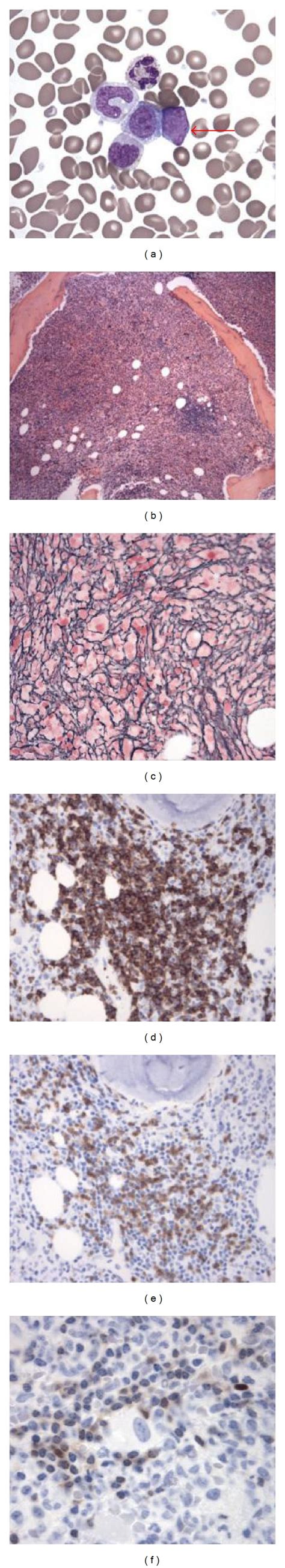 Primary myelofibrosis, fibrotic stage: (a) peripheral blood smear ...