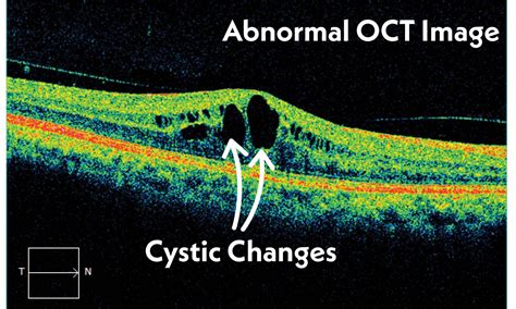 What Does an OCT Photo Capture and Why is it Necessary? | Tennessee Retina