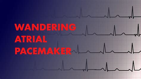 wandering atrial pacemaker ecg - Captions Editor