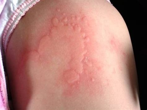 Treatment Of Common Allergic Reactions | PM Press