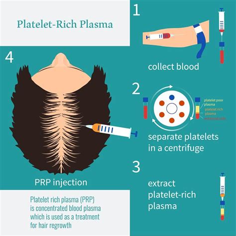 Platelet-Rich plasma is a newly developed process to assisted hair ...