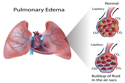 Pulmonary Edema: Causes, Symptoms, and Prevention