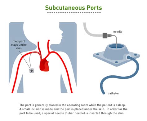 The Port a Cath - The Cancer Majlis