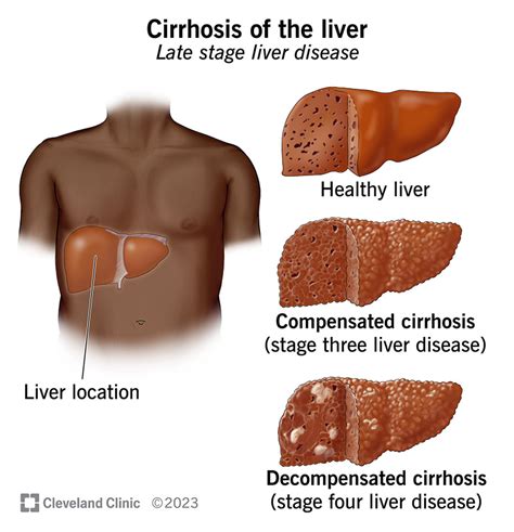 Cirrhosis of the Liver: Signs & Symptoms, Causes, Stages