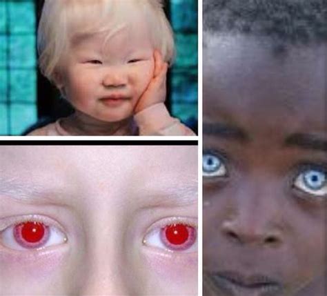 Ocular Albinism – Diminished Melanin in the eyes, skin and hair ...