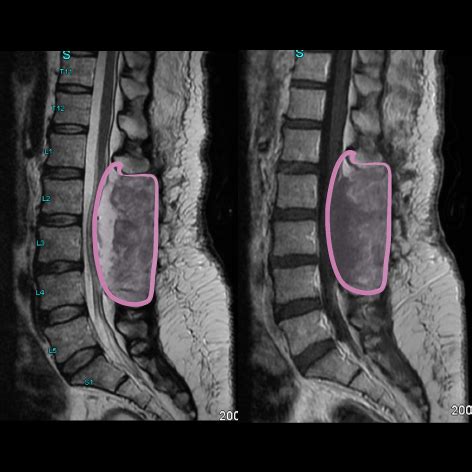 Cauda Equina Anatomy Mri