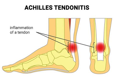 Achilles Tendon Rupture Surgery NJ | Achilles Tendon Tear Repair