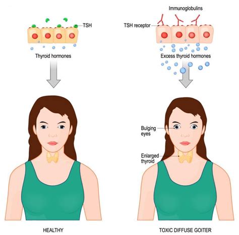 What is thyroid eye disease and can it be treated?: Lowcountry Eye ...