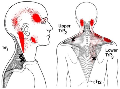 Trapezius Trigger Points Referred Pain