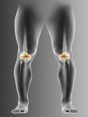 Bilateral Knee Replacement Houston, TX | Bilateral Knee Arthroplasty ...