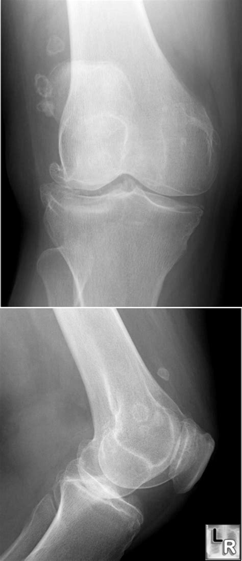 synovial osteochondromatosis : 네이버 블로그