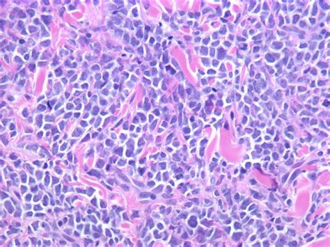 Pathology Outlines - Leukemia cutis