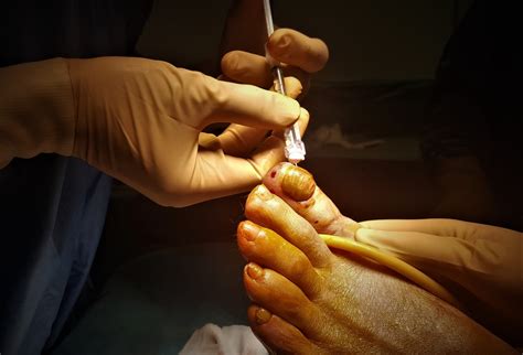 Toenail Removal Surgery - Everything You Need to Know | GNFO