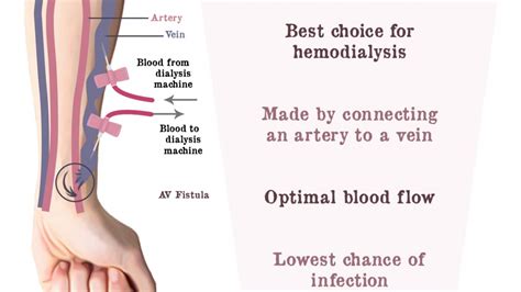 How to take care AV Fistula for dialysis