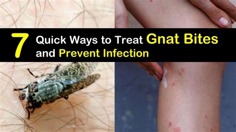 7 Quick Ways to Treat Gnat Bites and Prevent Infection | Gnat bites ...