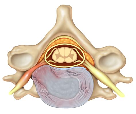 Pinched Nerve in Neck: Causes, Symptoms, and Treatments