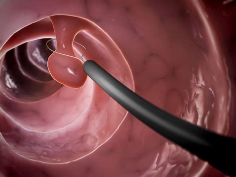 What to Do About Precancerous Polyps