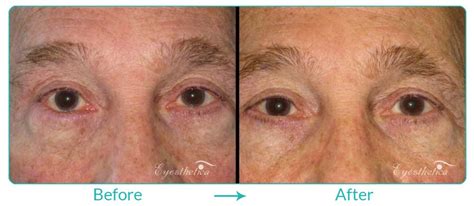 Entropion Eyelid Repair Gallery LA - Eyesthetica