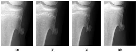 JCM | Free Full-Text | Treatment Strategy of Fractured Osteochondroma ...