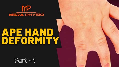 Ape Hand Deformity - part 1 | Introduction | In Hindi | Mera Physio ...