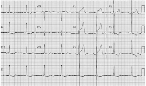 Diagnosis of Aortic Stenosis | Hope For Hearts Australia