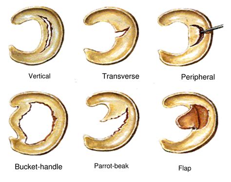 Mri Of Torn Knee Meniscus And Cyst Tattoos