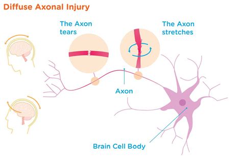 Traumatic Brain Injury (TBI) - Headway