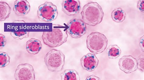 Reblozyl® (luspatercept-aamt) Importance of Testing - MDS | For HCPs