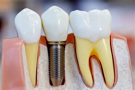 Dental Implant Procedure Steps | Adam Fienman, DDS | West Bloomfield