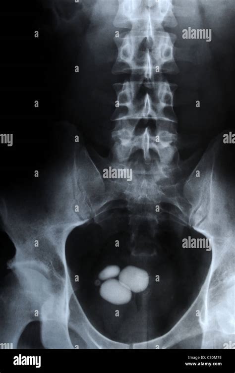 [View 40+] Kidney Stone Image Xray