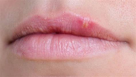 Bump on lip: Causes, treatment, and when to see a doctor