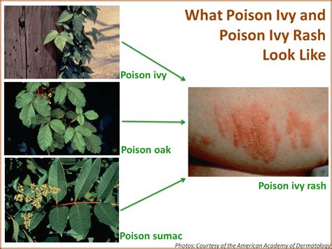 How To Take Off Poison Ivy Rash