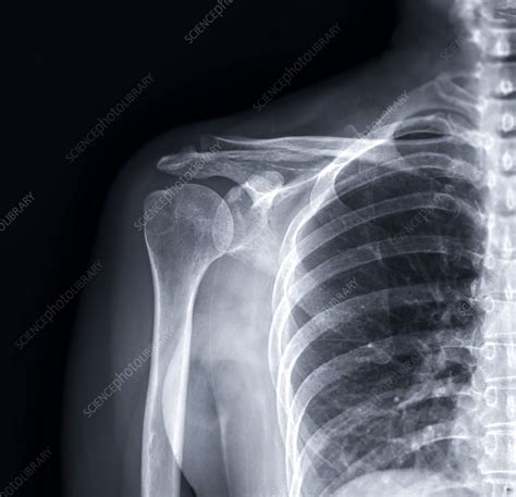 Fractured shoulder, X-ray - Stock Image - F037/5140 - Science Photo Library