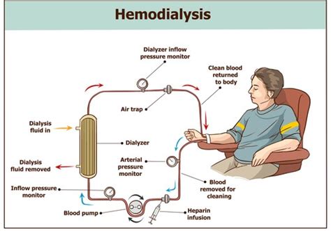 Dialysis Procedure