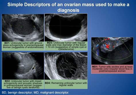 Would a regular ultrasound be able to differnciate a benign ovarian ...