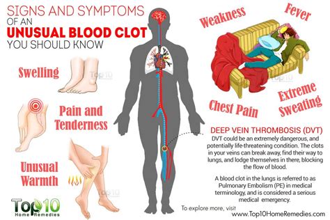 10 Signs & Symptoms of an Unusual Blood Clot You Should Know | Top 10 ...