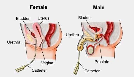 Urinary Catheterization Nursing Procedure & Management - Nurseslabs