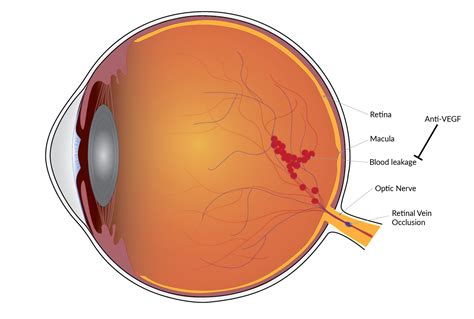 Treatment for macular edema has long-lasting gains | National ...