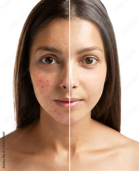 Woman face before and after acne treatment procedure. Skin care concept ...