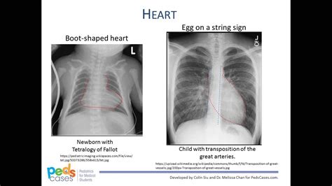 Pediatric Chest Xray Interpretation Youtube