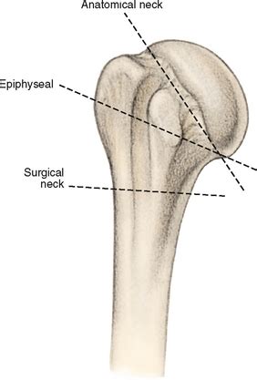 Fractures of the Proximal Humerus | Musculoskeletal Key