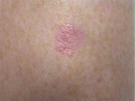 Basal Cell Carcinoma Pictures