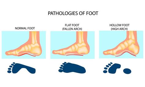 Do You Know Your Foot Type? (And Why You Should): Premier Podiatry ...