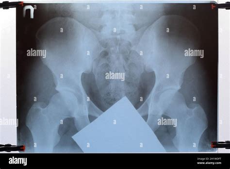 X-ray of the pelvis and sacrum. X-ray image Stock Photo - Alamy