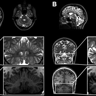 Example of MRI findings, specifically T2 signal of the dentate nuclei ...